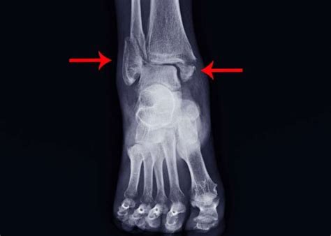 Fracture Broken Ankle Sprain