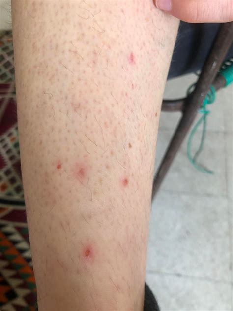 Skin Concern Red Bumps All Over Lower Legs Not Raisedswollenwhat