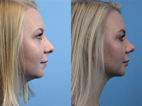 Rhinoplasty Before And After Pictures Case 227 West Des Moines And Ames