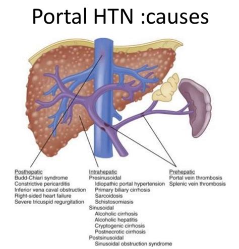 Portal Hypertension Differential Diagnosis Hepatology
