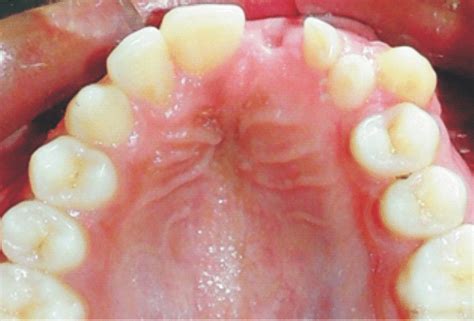 Buccal And Palatal Swelling Was Evident In Anterior Maxillary Region