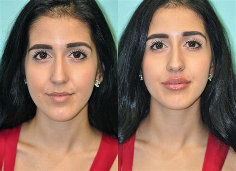 Before And After Photos Of Lip Injections