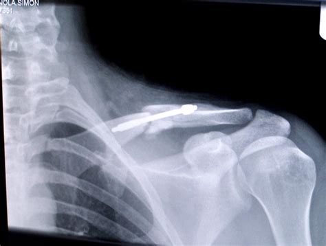 My Broken Clavicle After Fresh Off The Xray Machine Thi Flickr
