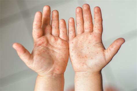 hand foot and mouth disease hfmd symptoms and treatment
