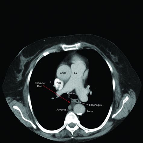 Thoracoscopic Ligation Of The Thoracic Duct Ctsnet