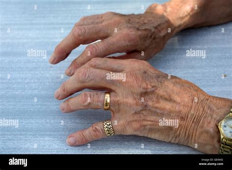 Rheumatoid Arthritis Hands Hi Res Stock Photography And Images Alamy