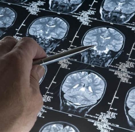 The Anatomy Of Brain Trauma Concussion And Coma Brainline