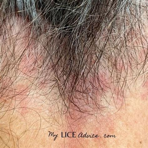 Discover 17 Common Head Lice Symptoms With Pictures And Find Out The