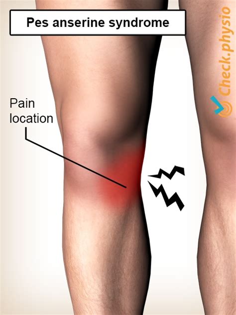 Pes Anserinus Syndrome Physio Check