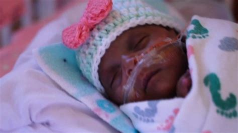Worlds Smallest Surviving Premature Baby Released From Us Hospital