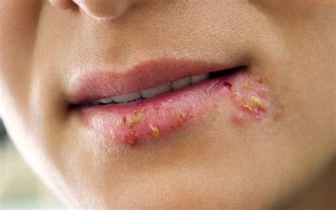 Herpes labial o que é sintomas causas e tratamento Vitat