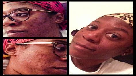 Check spelling or type a new query. Clear Acne using African Black Soap | Fade Dark Spots ...
