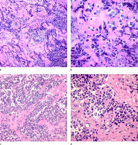 Primitive Neuroectodermal Tumor Arising In A Testicular Teratoma With