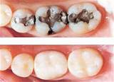 Remove Silver Fillings Images