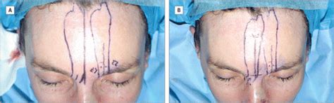 The Midline Central Artery Forehead Flap A Valid Alternative To