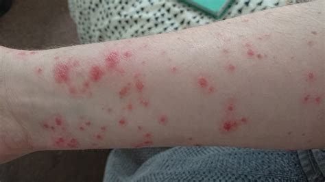 The Best 6 Guttate Psoriasis Pictures Legs Quoteqpast