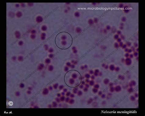 Microscopy Of Neisseria Meningitidis Gram Negative Diplococci N