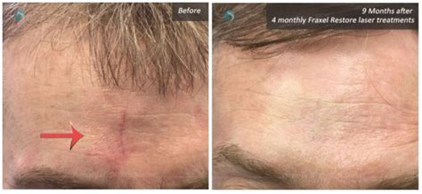 Fraxel Scar Removal Nyc Fraxel Laser Skin Resurfacing New York Ny
