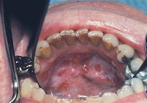Screening For And Diagnosis Of Oral Premalignant Lesions