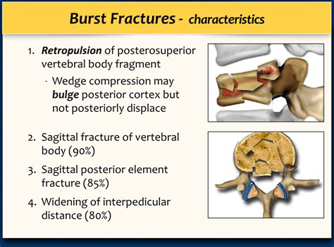Ao Classification Burst Fracture