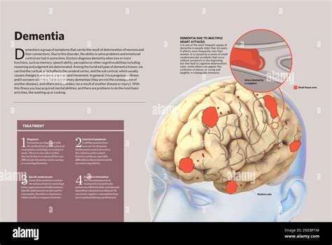 Infographic About Dementia A Progressive And Irreversible