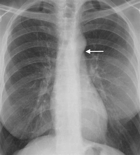 Frontal Chest Radiograph Displaying The Aortopulmonary Window White