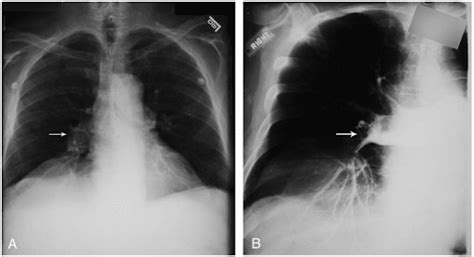 Tromboembolismo Pulmonar Na Radiologia De A A Z Medway