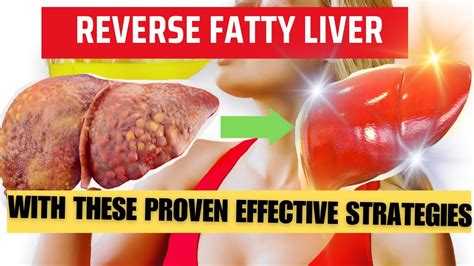 Reverse Fatty Liver Naturally With These Proven Effective Strategies
