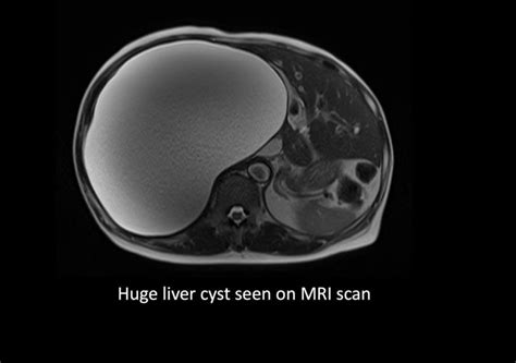 Liver Cystic Tumor Treatment In Singapore Ls Lee Surgery Clinic