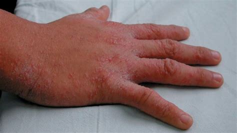 5 Causas De Sarpullido En La Muñeca Desde Alergias Hasta Eczema