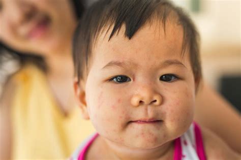 Roseola Causes Symptoms And Treatment