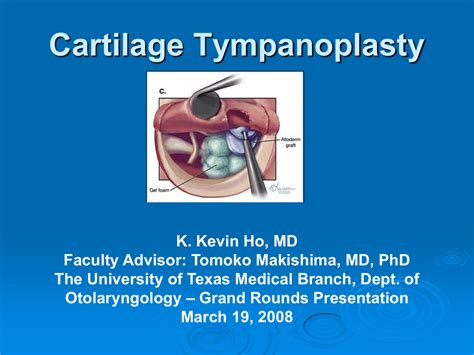 Cartilage Tympanoplasty Utmb Health The University Of Texas