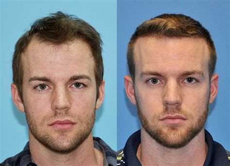It just fell out consistently until age 23 (fall 2015), where i first noticed i was visibly balding. 25 year old Male Hairline Restoration - Carolina Hair Surgery