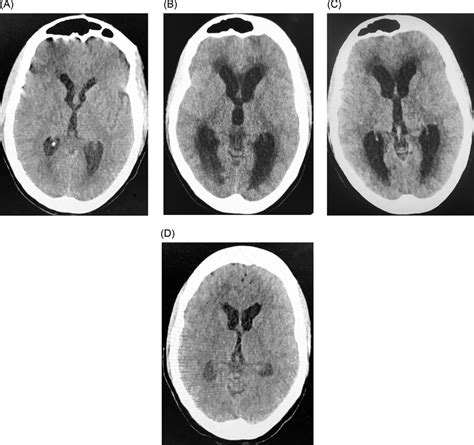 Non Contrast Ct Of The Brain A Admission To Hospital B Week 2 Of Download Scientific