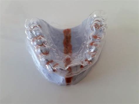 (fast) unsichtbar, elegant und dazu noch effektiv. Aligner Schienen Behandlung - Cultus Dentes