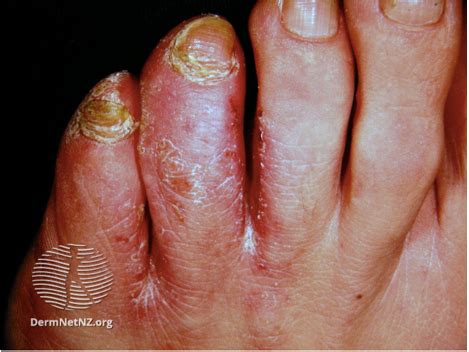Dermatophyte Skin Infections HSE Ie