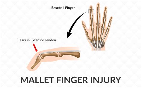 Mallet Finger Injury Dr Saurabh Aggarwal