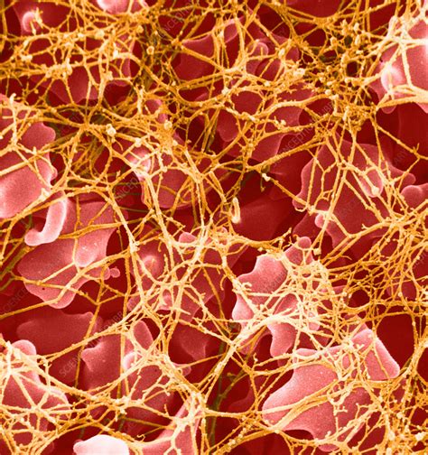 The ultrasound machine uses sound waves to create pictures of the inside of your body. Blood Clot, SEM - Stock Image - C028/1860 - Science Photo ...