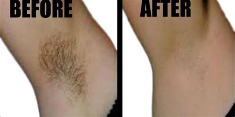 You Only Need 2 Ingredients And 2 Minutes To Get Rid Of Underarm Hair Forever Sara Beauty And