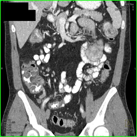 Inflammed Jejunal Loops Due To Infectious Enteritis Gastrointestinal