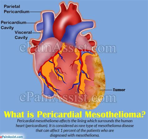 Pericardial Mesotheliomacausessignssymptomsdiagnosis