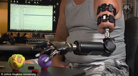 Man Moves His Robotic Arms With His Mind Brain Controlled Prosthetic