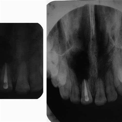 Pathogenesis Of Radicular Cyst A Carious Tooth Showing A Periapical