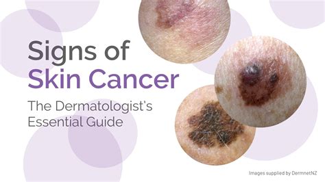 Skin Cancer Signs Symptoms The Dermatologist S Essential Guide