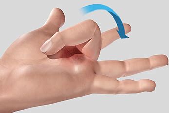 The tendons on the palm side of the hand. Trigger Finger Fountain Valley CA | Flexor Tendonitis ...