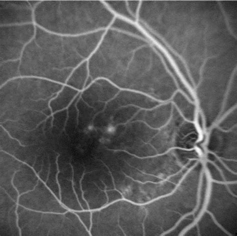 Figure 1 From Intravitreal Bevacizumab For Photodynamic Therapy Induced