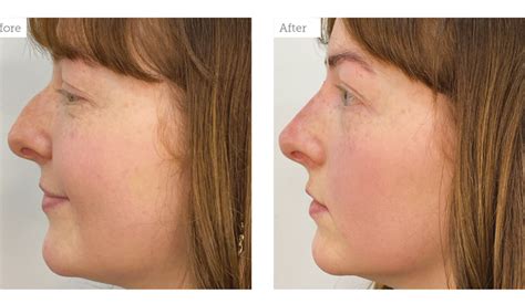 Advertorial Advancing Your Non Surgical Rhinoplasty Results Aesthetics