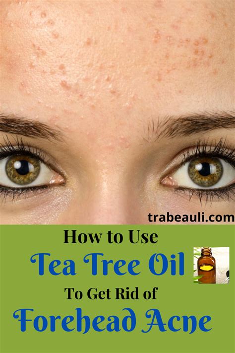 How To Get Rid Of Acne On Forehead Naturally Beauty And Lifestyle