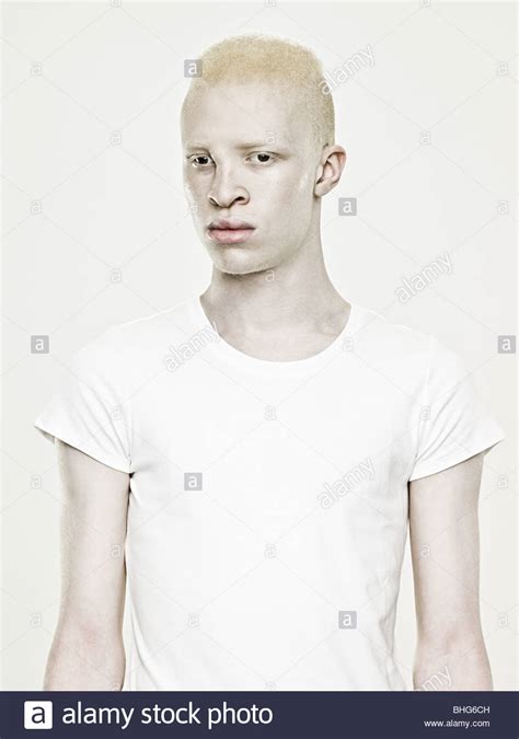 African Albino Stock Photos And African Albino Stock Images Alamy