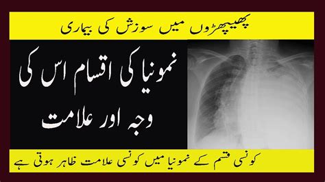 Not every woman has the sam. Pneumonia Type Cause And Symptoms In Urdu Phephron Ki Sozish Ki Alamat Iqsam Aur Waja - YouTube